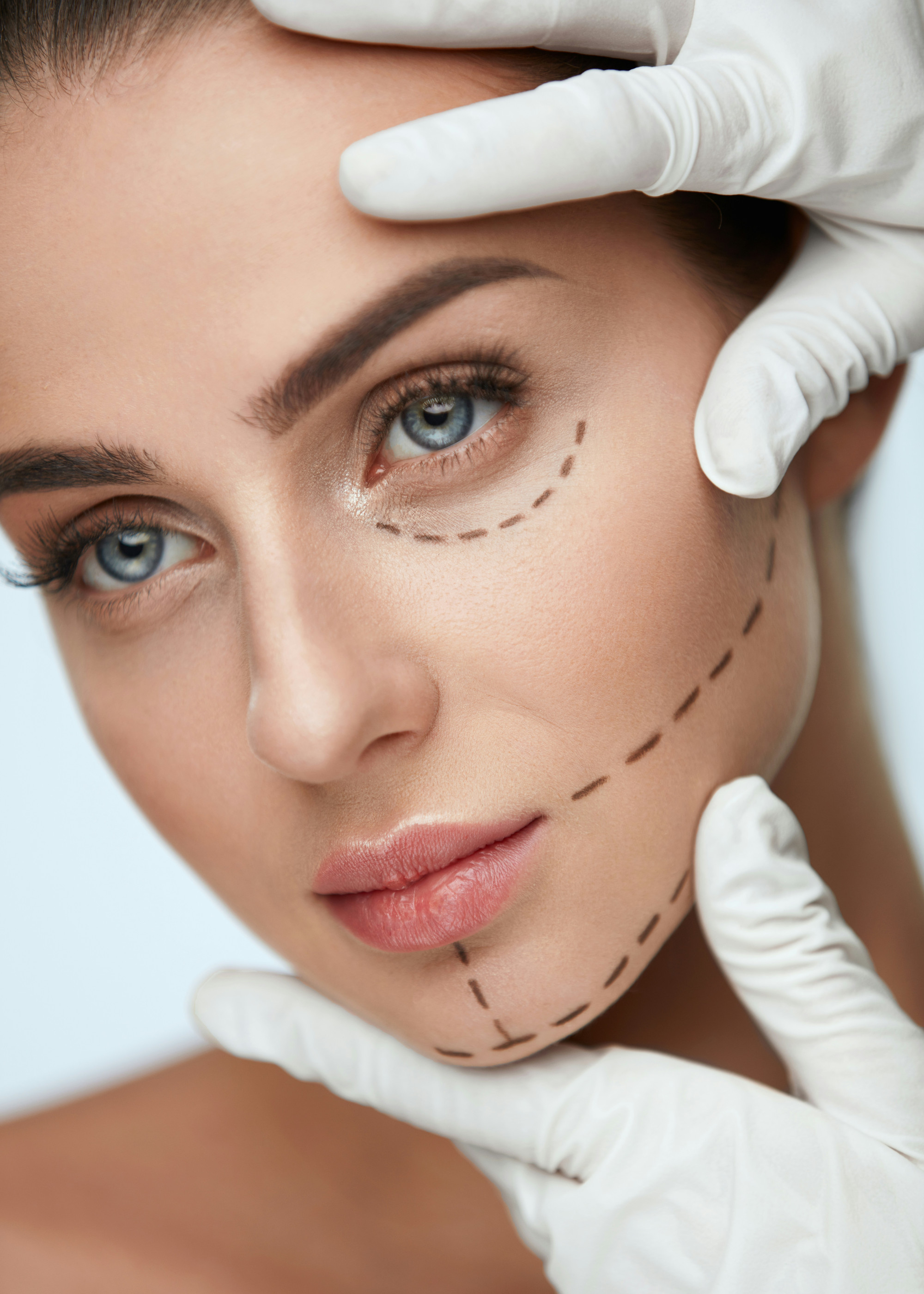 La blépharoplastie des paupières inférieures permet de corriger les poches, l'excès de peau, les creux palpébraux.